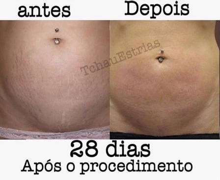 Tatuagem Para Cobrir Estrias Na Barriga Antes E Depois - Tatuador brasileiro que camufla estrias faz sucesso internacional e tem ...