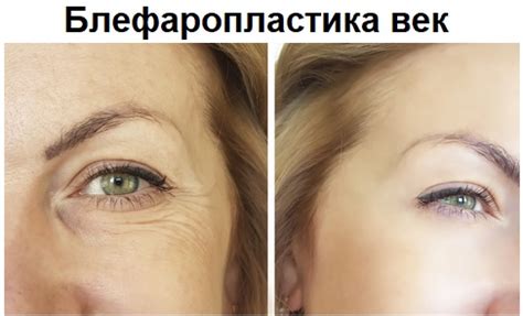 Блефаропластика До и После – Фото и Отзывы