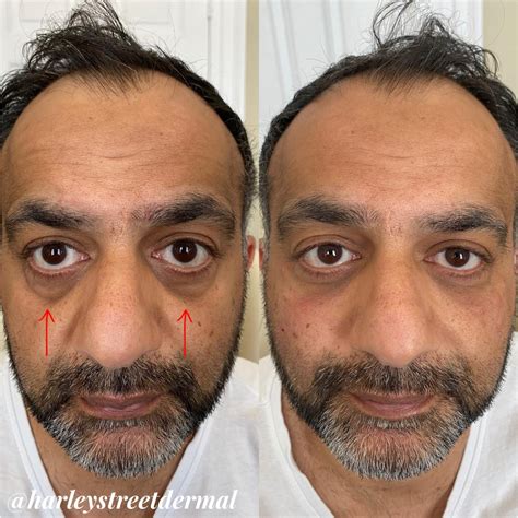 Dark Circles Treatment in London | Harley Street Dermal