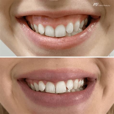 Before and After treatment pictures - M1 Med Beauty BG