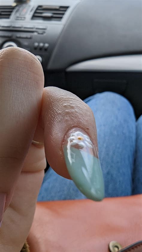 Warts starting on my pinky finger? : r/Warts