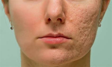 Uneven Skin Tone | Ozmedica Aesthetic Clinic Melbourne