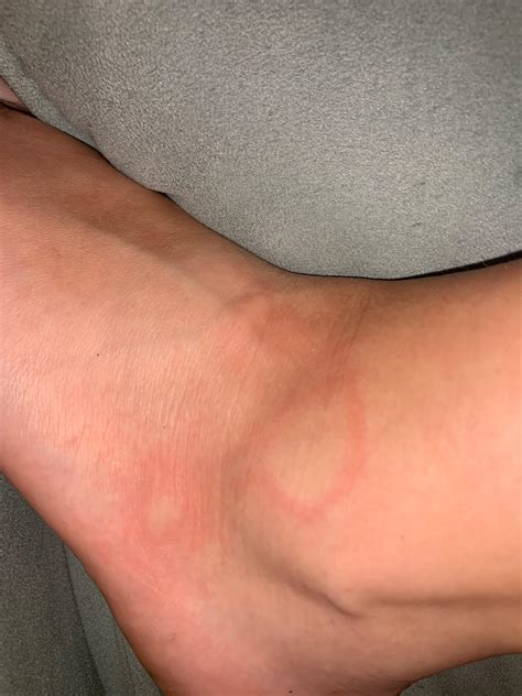 I’m allergic to red ants and just got bit. But why does it create that
