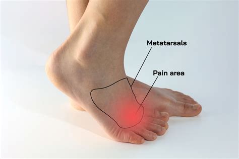 5 Exercises for Morton's Neuroma: Alleviate Your Foot Pain - Custom ...