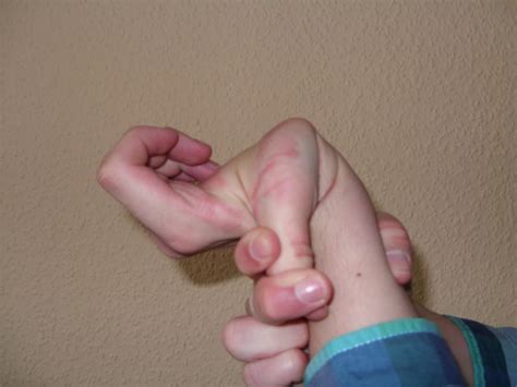 Ehlers-Danlos syndrome: Symptoms, causes, and treatment