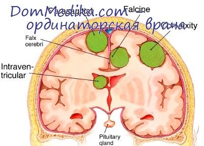 Роль ионизирующего излучения в развитии опухолей мозга. Облучение как ...