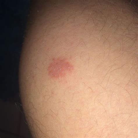 Ich habe hauptsächlich am Bein so rote juckende stellen (fühlen sich an