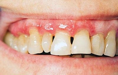 identifying gingivitis signs prevention techniques