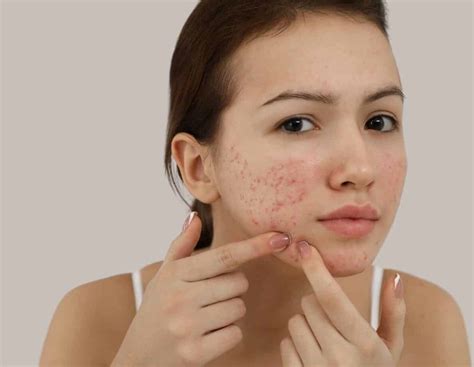 All You Need To Know About The Treatments for Teenage Acne
