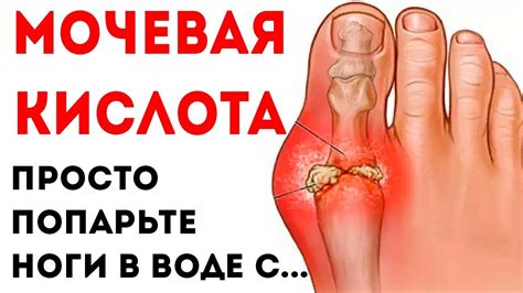 Мочевая кислота нормализуется, а подагра уменьшится, если выпить стакан ...