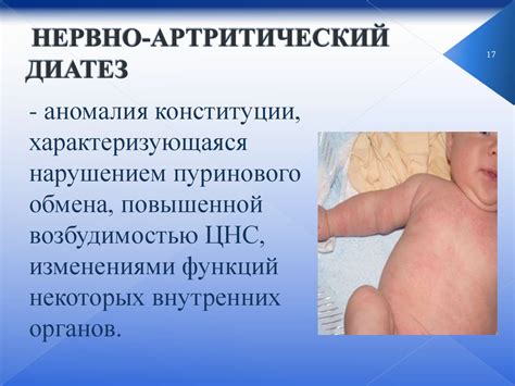 Аномалии конституции (диатезы) - презентация онлайн