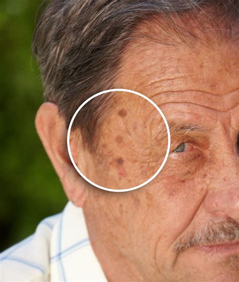 Sk S On The Face Seborrheic Keratosis Pinterest Face | My XXX Hot Girl