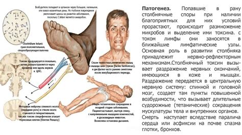 Столбняк (Tetanus) - презентация онлайн