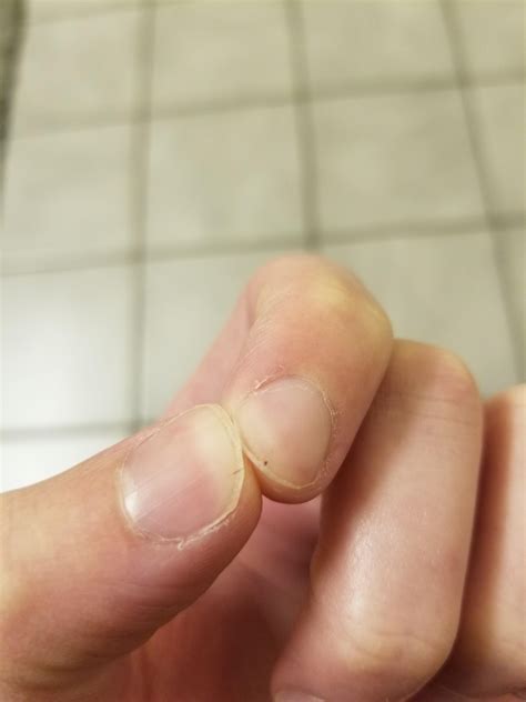 Should I be worried? Speck/line under finger nails : r/Dermatology