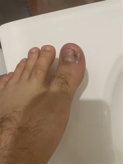 Side of big toe hurts : r/Ingrown_Toenails