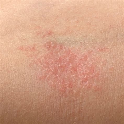 Atopic Dermatitis (ICD-10: L20) - Online consultation AI dermatologist