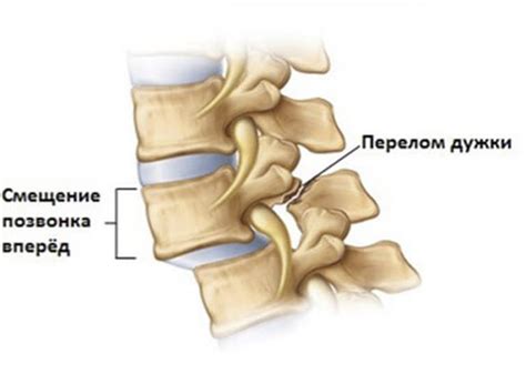 Спондилолистез позвоночника - MedClinic