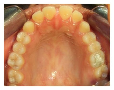 pretreatment  upper    arch  scientific diagram