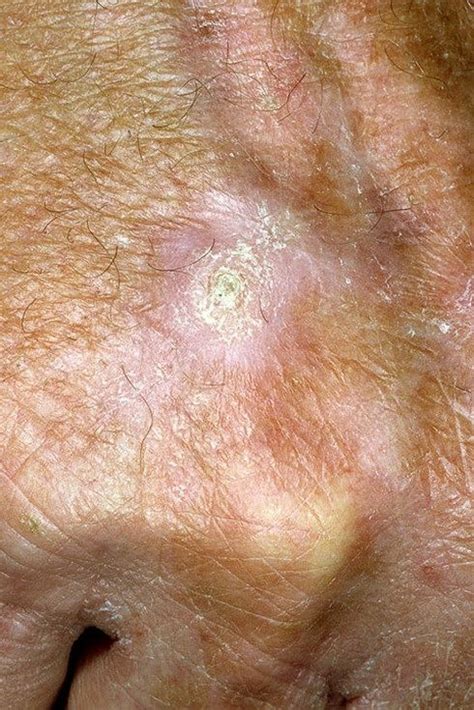 Рак кожи на руках фото – 16 шт. / fotodiagnoz.com