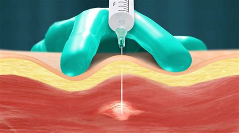 trigger point injections central states pain clinic