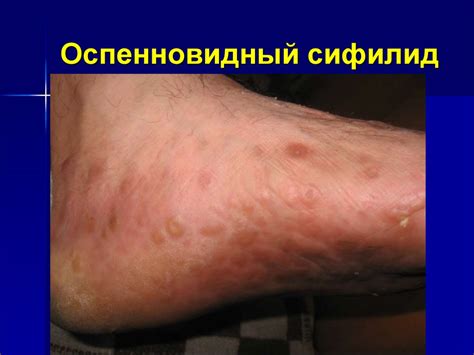 Сифилис. Этиология. Патогенез. Классификация. Клинические проявления ...