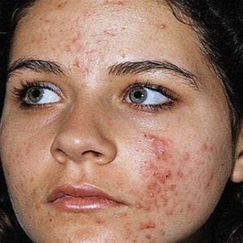 Remove the Pimple Marks on Face Overnight at Home — Steemit | Acne scar ...