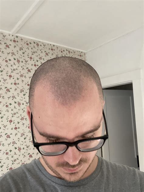 It’s so weird to think about going bald and then actually start going