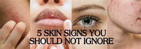 skin signs    ignore  ki advice