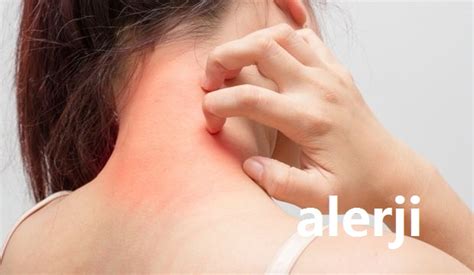 alerji - BilginCin