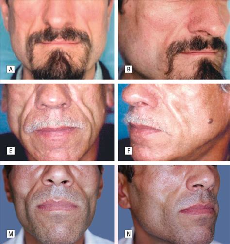 Aids Symptoms In Face