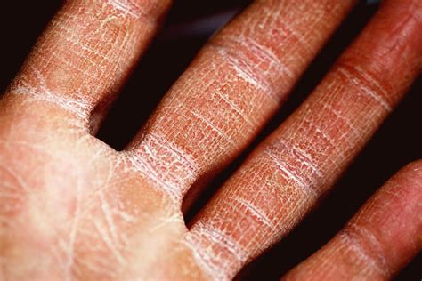 Diffuse Systemic Scleroderma Causes Worse Outcomes - Patient Worthy