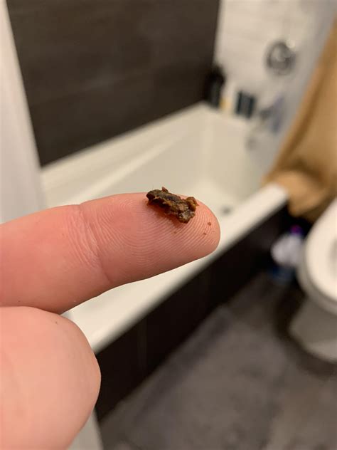 popping blackheads behind ears 5