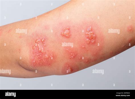 shingles zoster  herpes zoster symptoms  arm stock photo alamy