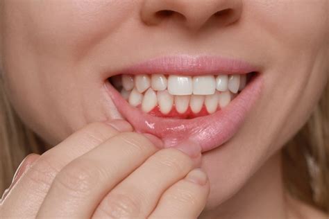 Common Signs of Gum Disease - Vineyard Valley Dental Temecula California