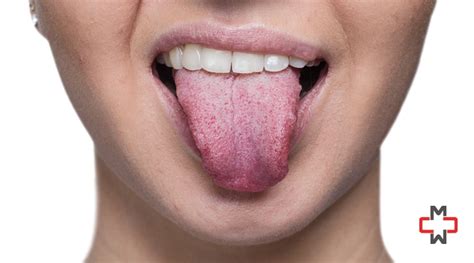 Tongue Bumps: Causes and Treatment