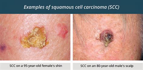 Skin Cancer Types Squamous Cell Carcinoma Symptoms Vr - vrogue.co
