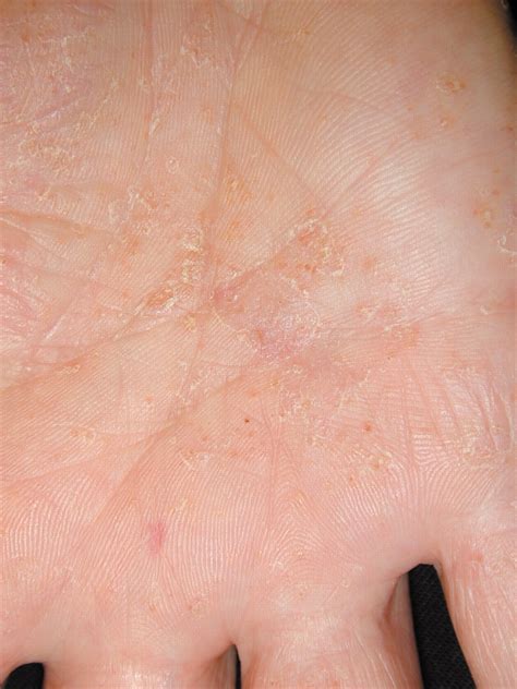 Atopic Dermatitis Palms