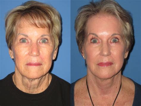 facelift    dr james pearson facial plastic surgery