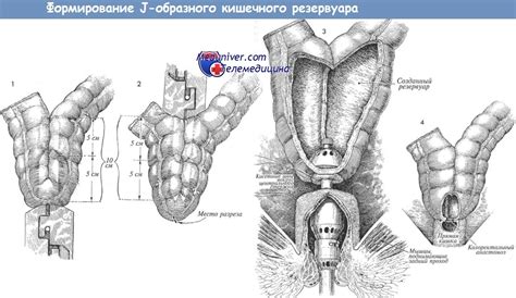 Кишечные резервуары - классификация, последствия формирования, обследование
