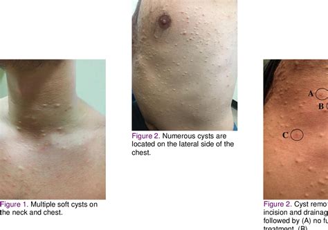 steatocystoma multiplex case report  review  treatment semantic