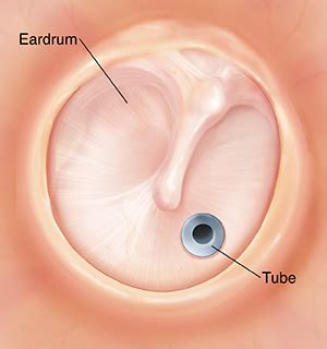 Tympanostomy (Ear Tube) | Saint Luke's Health System