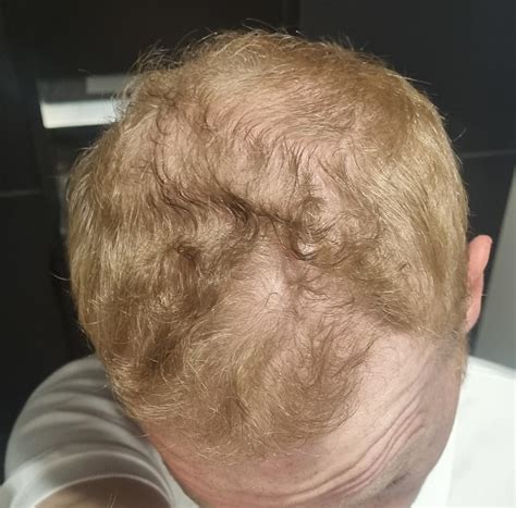 Balding
