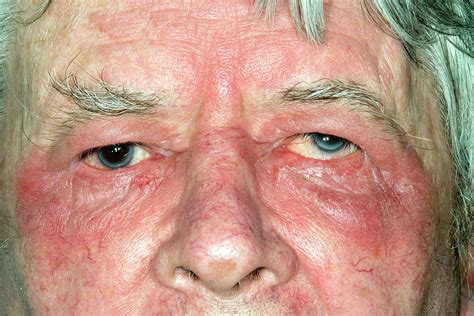 Eczema Around The Eye Photograph by Dr P. Marazzi/science Photo Library