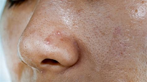 Acne Vulgaris Causes, Pathogenesis, Influencing Factors,, 40% OFF