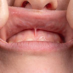Подрезание уздечки верхней или нижней губы у детей – как проходит операция