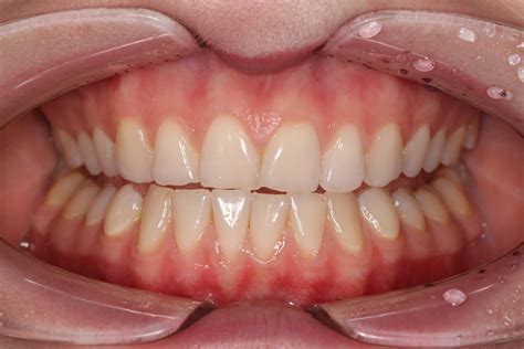 Что такое правильный прикус и почему он важен? | Dentell