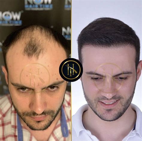 Пересадка волос in 2023 | Hair, Eyebrow transplant, Hair transplant