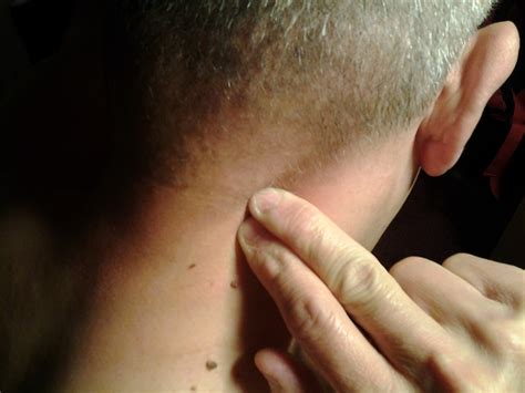 Occipital Neuralgia can be the result of of pinched nerves or muscle