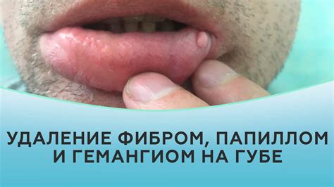 Удаление фибром, папиллом и гемангиом на губе - YouTube