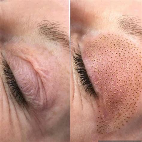 Plasma Pen / Fibroblast - Abbie Victoria Aesthetics